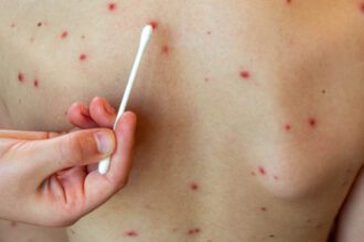 Sarampión: Salud confirma segundo caso en Costa Rica en marzo 2026