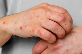 Sarampión en Moravia