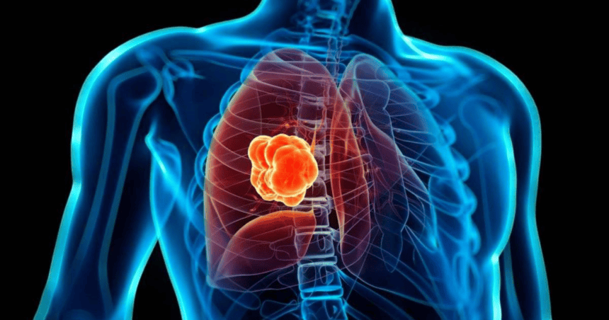 divarasib-cancer-pulmon-kras