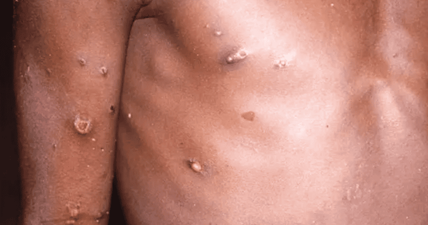   Viruela símica: Salud confirma dos casos activos en San José