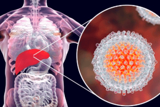 ¡Alerta sanitaria! Alarmante aumento de casos de hepatitis A azota al país