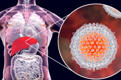 ¡Alerta sanitaria! Alarmante aumento de casos de hepatitis A azota al país