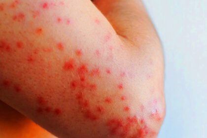 sarampión, moravia, liceo de moravia, inciensa, ministerio de salud, ccss, pococí, dulce nombre de coronado, brote, vacunación, epidemiología